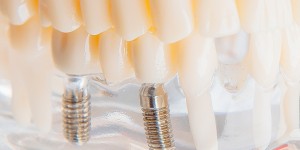 Implantologie dentara Bucuresti